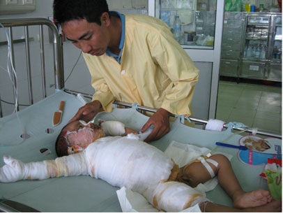 Thương bé 2 tuổi bị bỏng nặng - 2