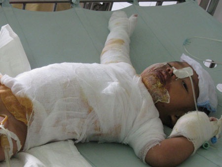 Thương bé 2 tuổi bị bỏng nặng - 3