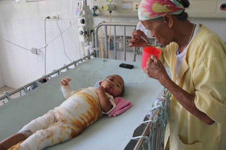 Bé 2 tuổi nguy kịch vì bỏng nước sôi toàn thân - 1 Bé 2 tuổi nguy kịch vì bỏng nước sôi toàn thân - 1