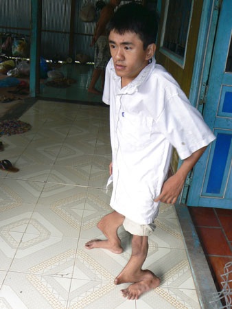 Hai anh em hơn 70 lần... gãy chân - 1 Hai anh em hơn 70 lần... gãy chân - 1