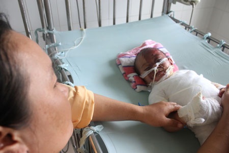 Nghịch nước sôi, bé 15 tháng tuổi hỏng nửa khuôn mặt - 3 Nghịch nước sôi, bé 15 tháng tuổi hỏng nửa khuôn mặt