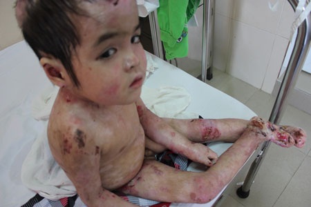 Xót thương cậu bé 5 tuổi không có ngón chân