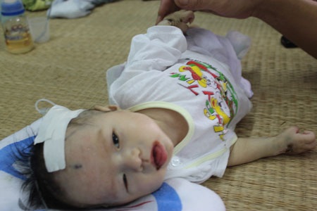 Bé Thu Trang đáng thương cùng lúc mắc nhiều bệnh hiểm nghèo đang rất cần sự hỗ trợ từ bạn đọc