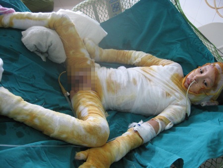 Không có bảo hiểm chi trả, bố mẹ không biết xoay đâu ra tiền chữa cho Đạt