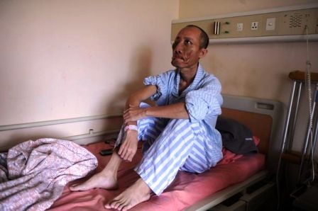 Gặp người đàn ông được gỡ bỏ khối u khổng lồ trên mặt