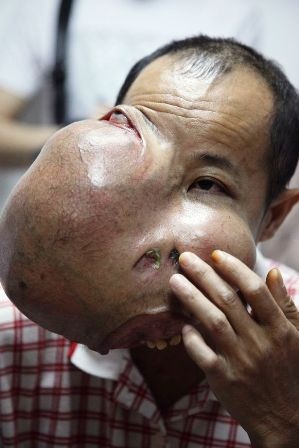 Gặp người đàn ông được gỡ bỏ khối u khổng lồ trên mặt