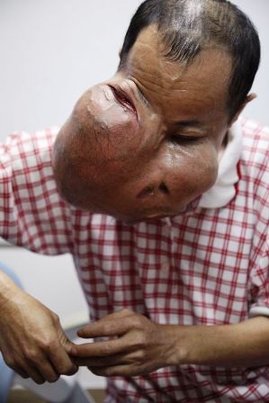 Gặp người đàn ông được gỡ bỏ khối u khổng lồ trên mặt