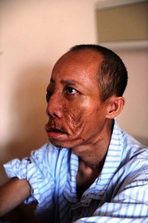 Gặp người đàn ông được gỡ bỏ khối u khổng lồ trên mặt