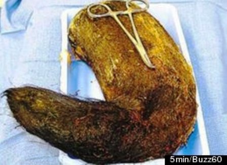 Số tóc được phát hiện trong dạ dày của cô gái trẻ