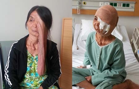 Chị Tuyết thời điểm trước và sau mổ