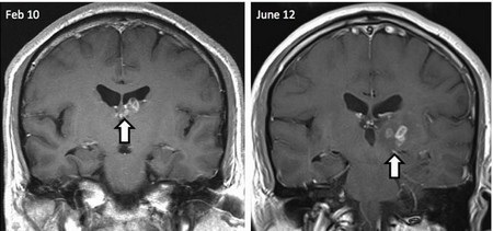 Ảnh cộng hưởng từ cho thấy sán dây di chuyển và gây tổn thương cho mô não của bệnh nhân