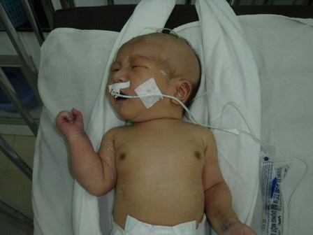 Bé Nhân Hòa đã bước vào ca đại phẫu - 1