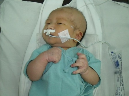 Ca phẫu thuật giành sự sống cho bé Nhân Hòa đã thành công - 1