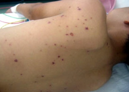 Một bệnh nhi bị suy gan, suy thận nặng vì ong đốt - 1