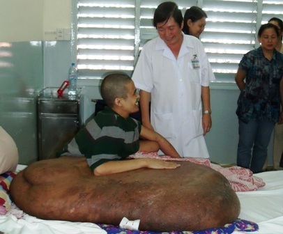 Người mang khối u khổng lồ sắp được “giải thoát” - 1 Người mang khối u khổng lồ sắp được “giải thoát” - 1