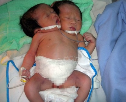 Bé sơ sinh hai đầu đã tử vong - 1