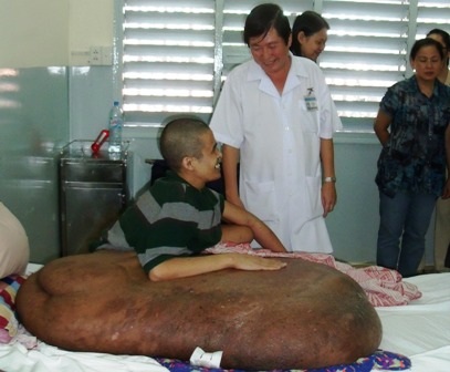 Cuối tháng 11 sẽ phẫu thuật cho người mang khối bướu khổng lồ - 1