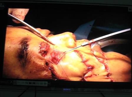 Bóc thành công “u quái” trả lại khuôn mặt cho thiếu nữ - 3