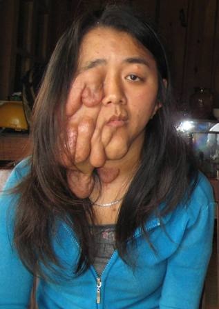 Bóc thành công “u quái” trả lại khuôn mặt cho thiếu nữ - 1