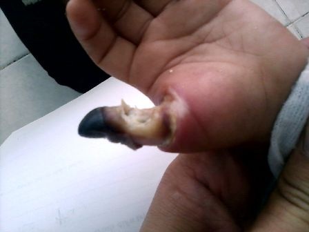 Bé trai mất ngón tay cái vì thọc vào ổ điện - 1