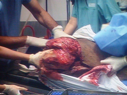 Ca phẫu thuật bóc khối bướu khổng lồ đã kết thúc - 1