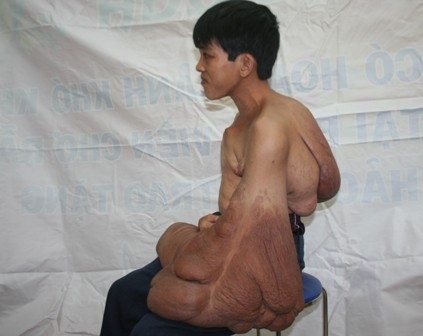 Dị nhân có cánh tay khổng lồ cần được giúp đỡ