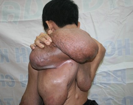 Dị nhân có cánh tay khổng lồ cần được giúp đỡ