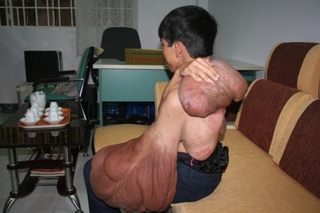 “Dị nhân” mang bướu khổng lồ cầu cứu - 2