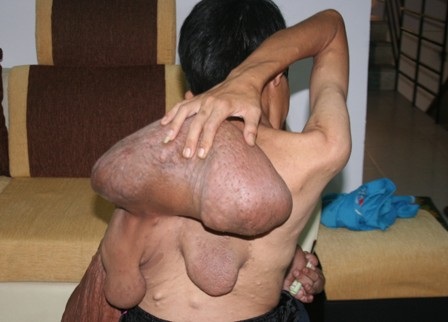 Bác sĩ Việt sẽ “tự tay” phẫu thuật cắt bỏ bướu sợi khổng lồ - 1