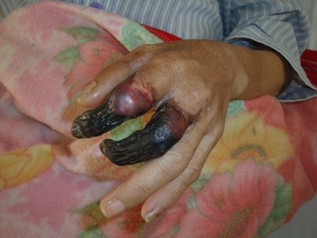 Bệnh uốn ván - Nhiều người nguy kịch vì chủ quan! - 2