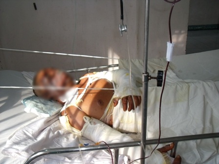 Bệnh nhân bỏng nặng vì mua xăng tự thiêu