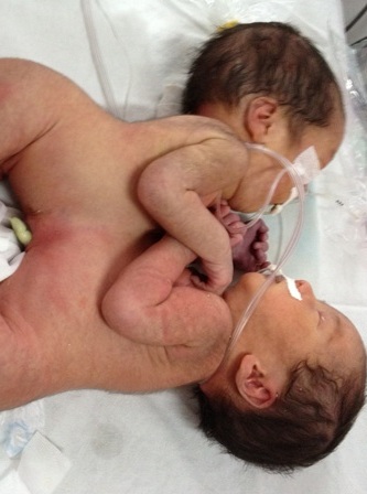 Hai bé gái này bị dính nhau tương đối phức tạp tại vùng ngực và bụng 