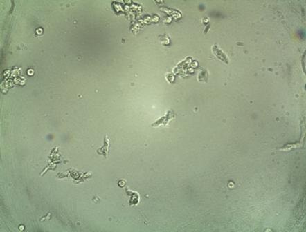 Hình ảnh amip ăn não được tìm thấy trong dịch não tủy của hai ca tử vong