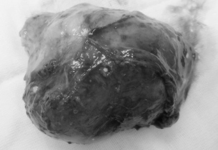 Khối u bóc ra có hình giống như trái tim