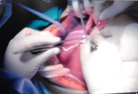 Ca ghép gan bước đầu đã thành công