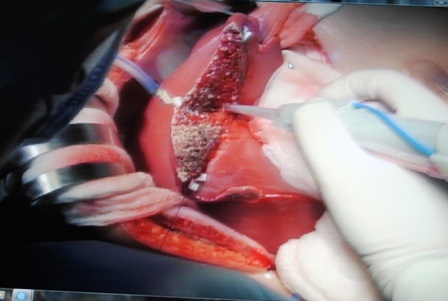 Dự kiến khoảng 12 tiếng cuộc ghép sẽ hoàn tất