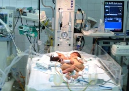 Chỉ trong vòng 1 tháng, bệnh viện Nhi Đồng 2 đã tiếp nhận 2 cặp song sinh dính nhau