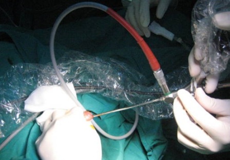 Qua nội soi bác sĩ đã chia nhỏ viên sỏi và gắp ra ngoài