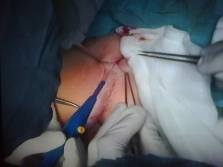 Sau gần 9 giờ cuộc phẫu thuật kết thúc với thành công ngoài mong đợi 