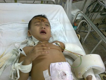 Bé trai cụt chân, mất cả cha lẫn mẹ trong tai nạn - 3 Nỗi đau thấu trời xanh trút xuống đầu đứa trẻ vô tội