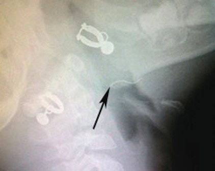 Cọng kẽm găm vào amidan bệnh nhi được phát hiện qua phim X-quang