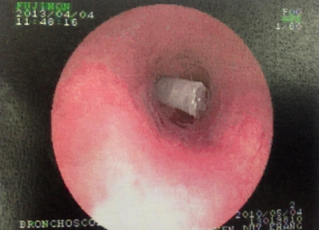Tiếng kèn rít “te… te” trong phổi bệnh nhi 3 tuổi - 1 Chiếc béc thổi nằm chắn ngang trong phế quản bệnh nhi