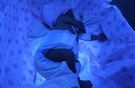 Cháu bé đang được chiếu đèn điều trị tích cực bệnh vàng da bẩm sinh