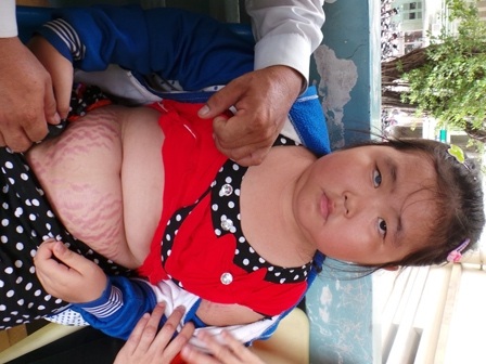 Nhiều vùng da trên cơ thể bé Linh rạn nứt như bà đẻ