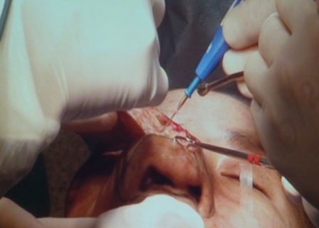 Dự kiến cuộc mổ sẽ kéo dài từ 10 đến 12 tiếng