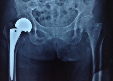 Ca phẫu thuật thay khớp háng nhiều rủi ro đã thực hiện hành công
