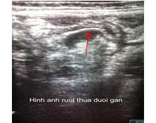 Cha mẹ chủ quan, bé 4 tuổi thủng ruột thừa - 1 Hình ảnh siêu âm cho thấy bé D bị thủng ruột thừa