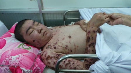 Nguyên nhân được xác định do bệnh lao da gây nên