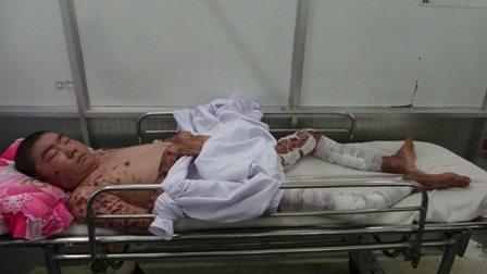 Khắp cơ thể của bệnh nhân lở loét hoại tử