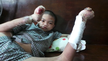 Dù đã bớt ngứa nhưng các vết thương ở đầu chi của Bảo còn rỉ máu 